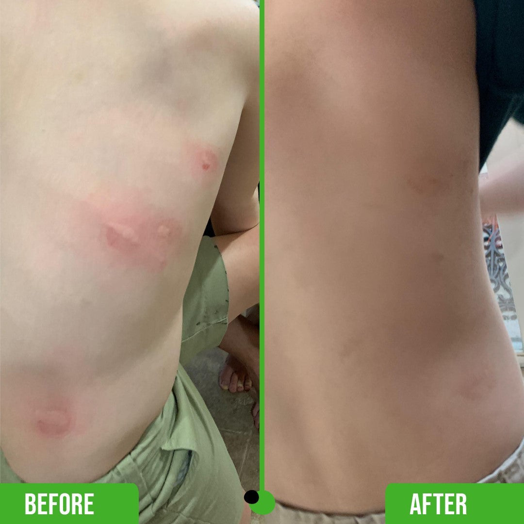 Photographs of  before and after use of the Bug Bite Thing. In the before picture the child has many bug bites that have products red welts and the after picture show that after using the Bug Bite Thing it has eliminated  the red welts.